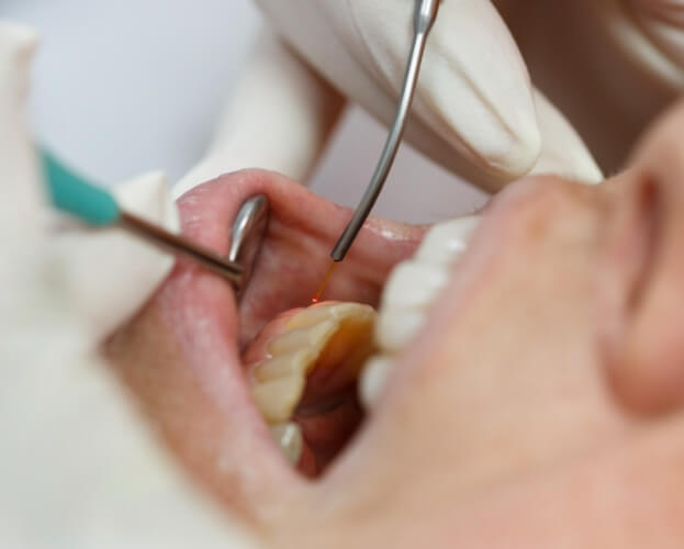 Dental patient receiving soft tissue laser dentistry services