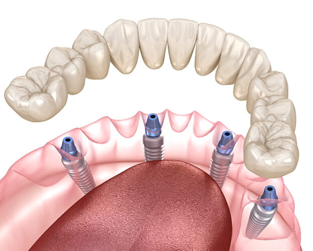 digital illustration of all-on-4 dental implants