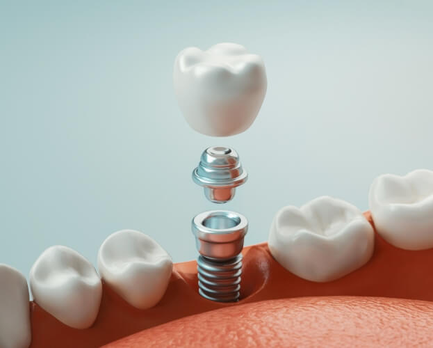 Animated smile during four step dental implant process