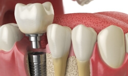 Animated smile showing dental implant osseointegration and abutment