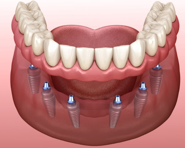 Animated dental implant retained denture placement