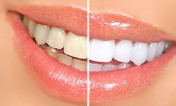 Before and after teeth whitening