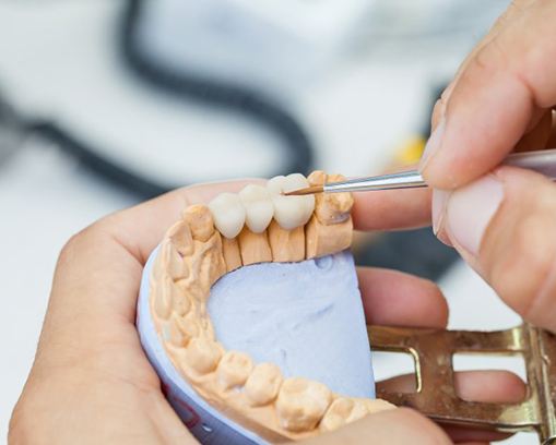 dentist creating a dental bridge in Casper 