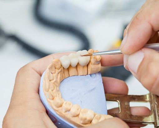 dentist creating a dental bridge in Casper