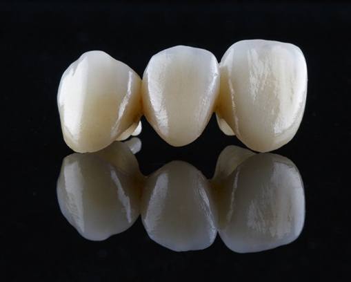 three part dental bridge in front of a black background 