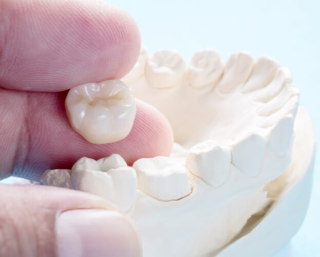 Model smile and all ceramic dental restorations