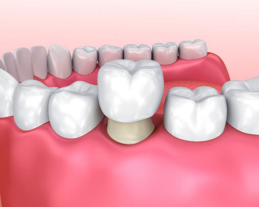 Patient at visiting the dentist to receive a dental crown in Casper, WY