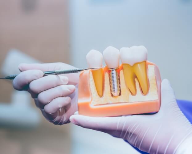 Dentist pointing to a dental implant model