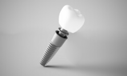 Animated dental implant supported dental crown