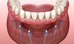 Digital illustration of implant dentures