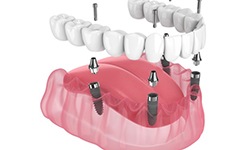 Illustration of implant dentures for lower arch