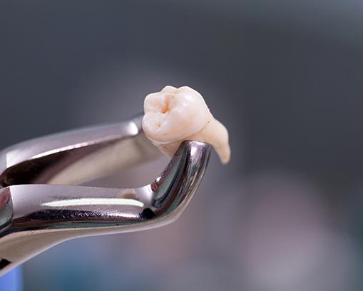 Closeup of extracted tooth held by forceps