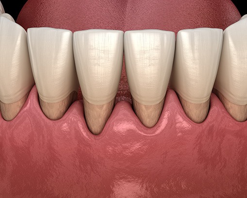 Gum disease treatment eliminates oral bacteria and protects the teeth and gums 