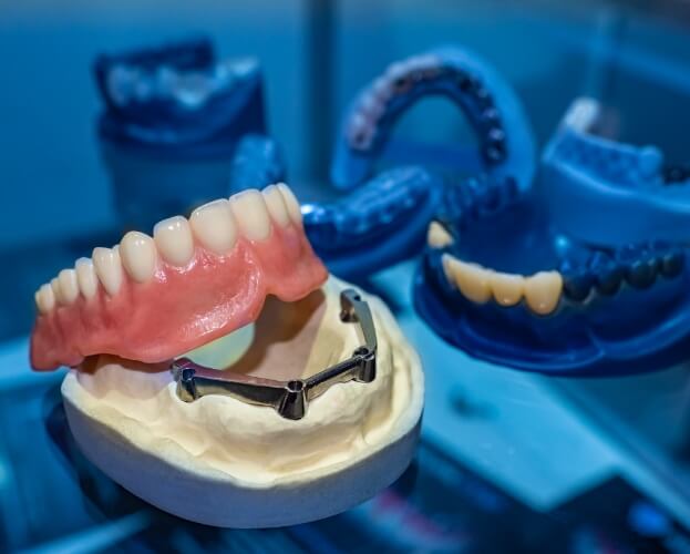 Model smile with dental implant supported denture