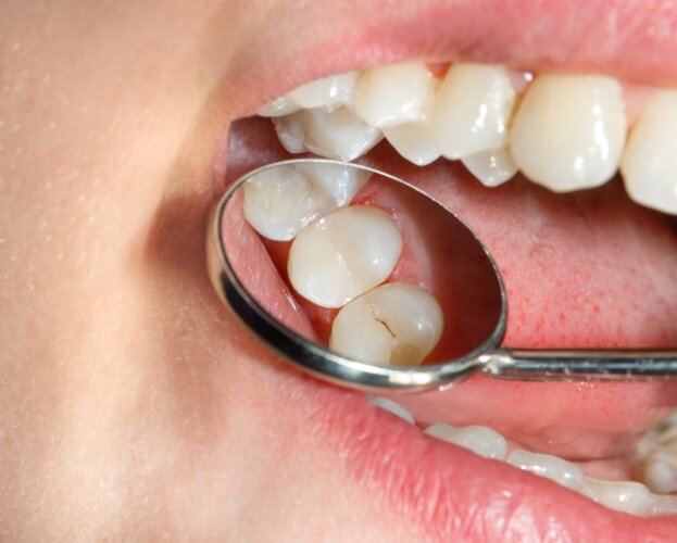 Dentist examining smile after dental sealant treatment