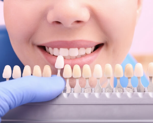 Smile compared with tooth colored filling restorative dentistry shade chart
