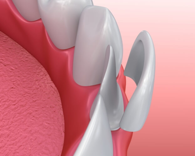 Animated smile during porcelain veneer placement
