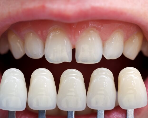 Smile before porcelain veneers compared to porcelain veneer options