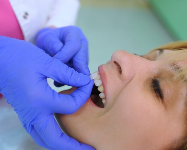 Dentist placing porcelain veneers