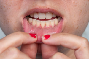 Woman pulling lip down to show receding gums