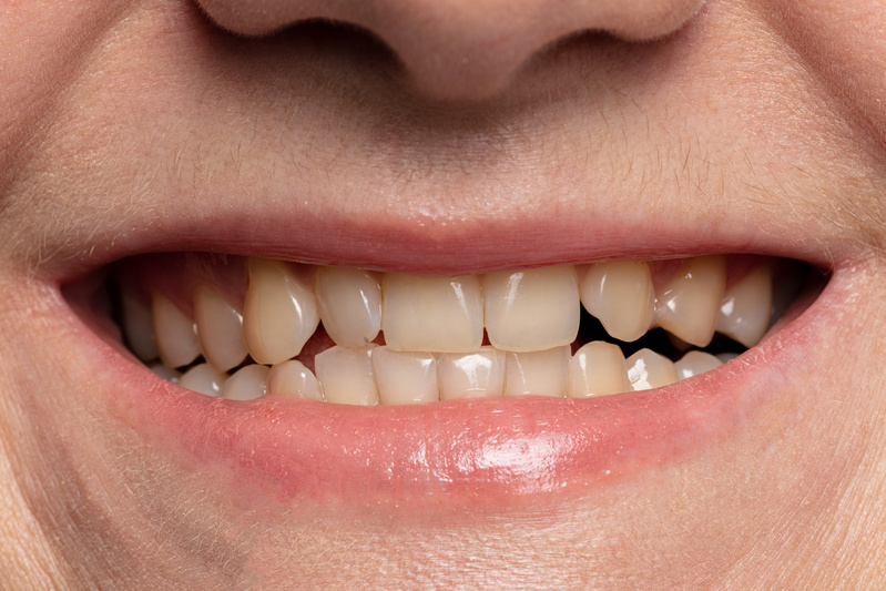 Close-up of smile with yellow teeth