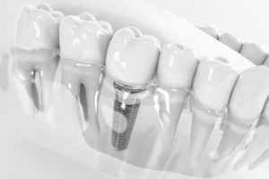 Black and white illustration of a dental implant inserted in lower arch