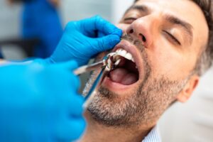 Man with mouth open preparing for tooth extraction.
